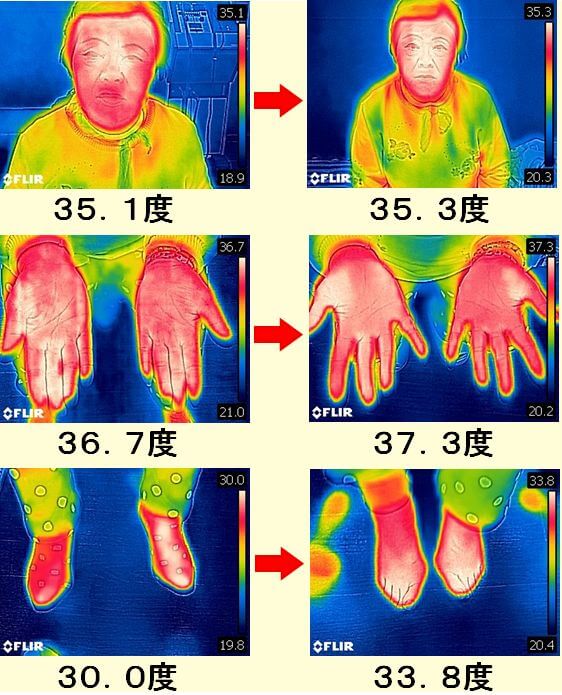 施術前と施術後の体温の変化のサーモグラフィーの写真
