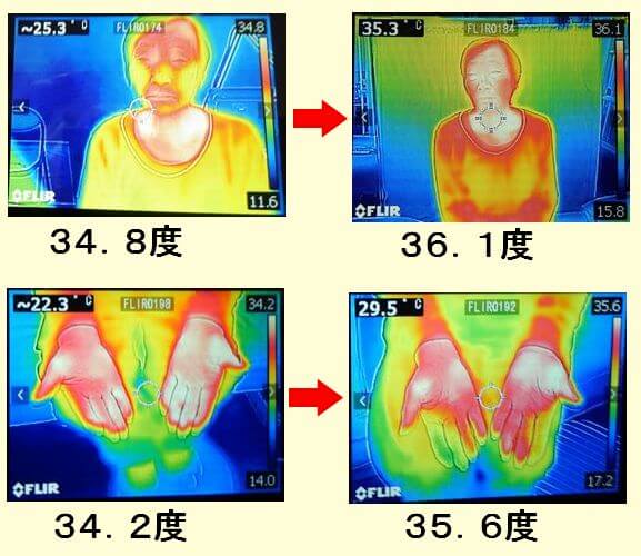 患者さんのサーモグラフィーの写真