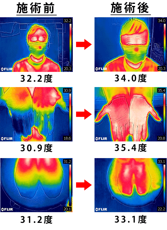 左胸部挫傷の女性の施術前後のサーモグラフィーの写真